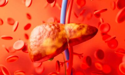 Leversteatose en cannabinoïden